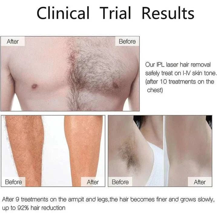 Permanent Laser IPL Hair RemovalPermanent Laser IPL Hair Removal